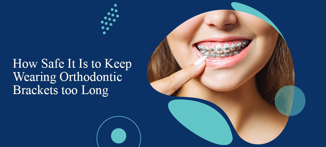 Orthodontic Brackets