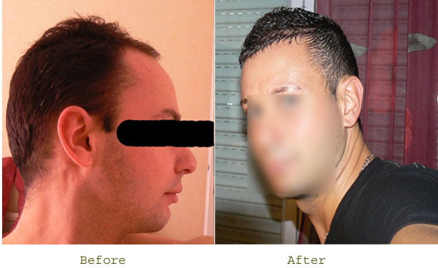 HAIR TRANSPLANT CLINIC